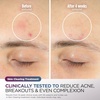 image:imageShark CryoGlow LED Face Mask in Rose Glow FW312PK  1 Skincare Facial Device in the US Combining HighEnergy LEDs Deep Infrared amp UnderEye CoolingLilac Chill