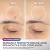 image:imageShark CryoGlow LED Face Mask in Rose Glow FW312PK  1 Skincare Facial Device in the US Combining HighEnergy LEDs Deep Infrared amp UnderEye CoolingRose Glow